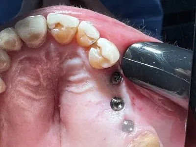 implant technique flapless ches les personnes sous anticoagulant