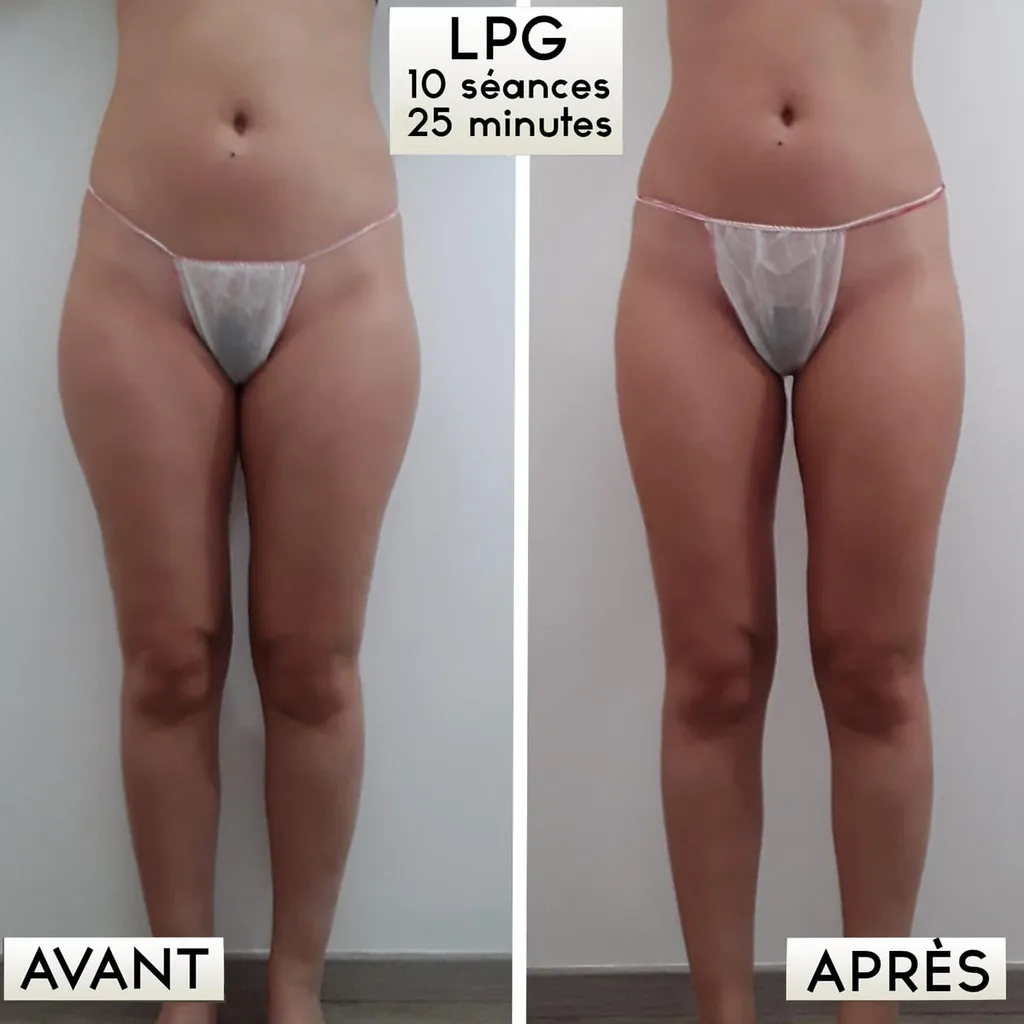 Programme LPG Minceur Global – Résultats Visibles