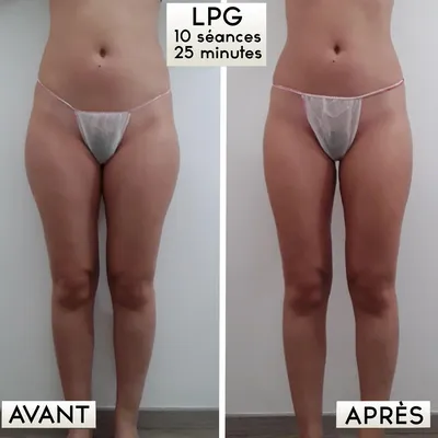 Programme LPG Minceur Global – Résultats Visibles