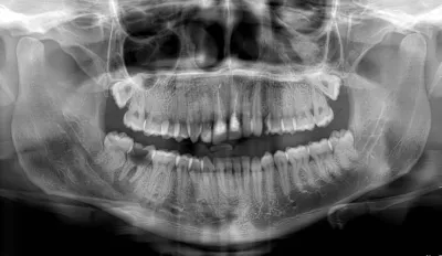Examen de panoramique dentaire dans notre centre d'imagerie médicale à Marseille