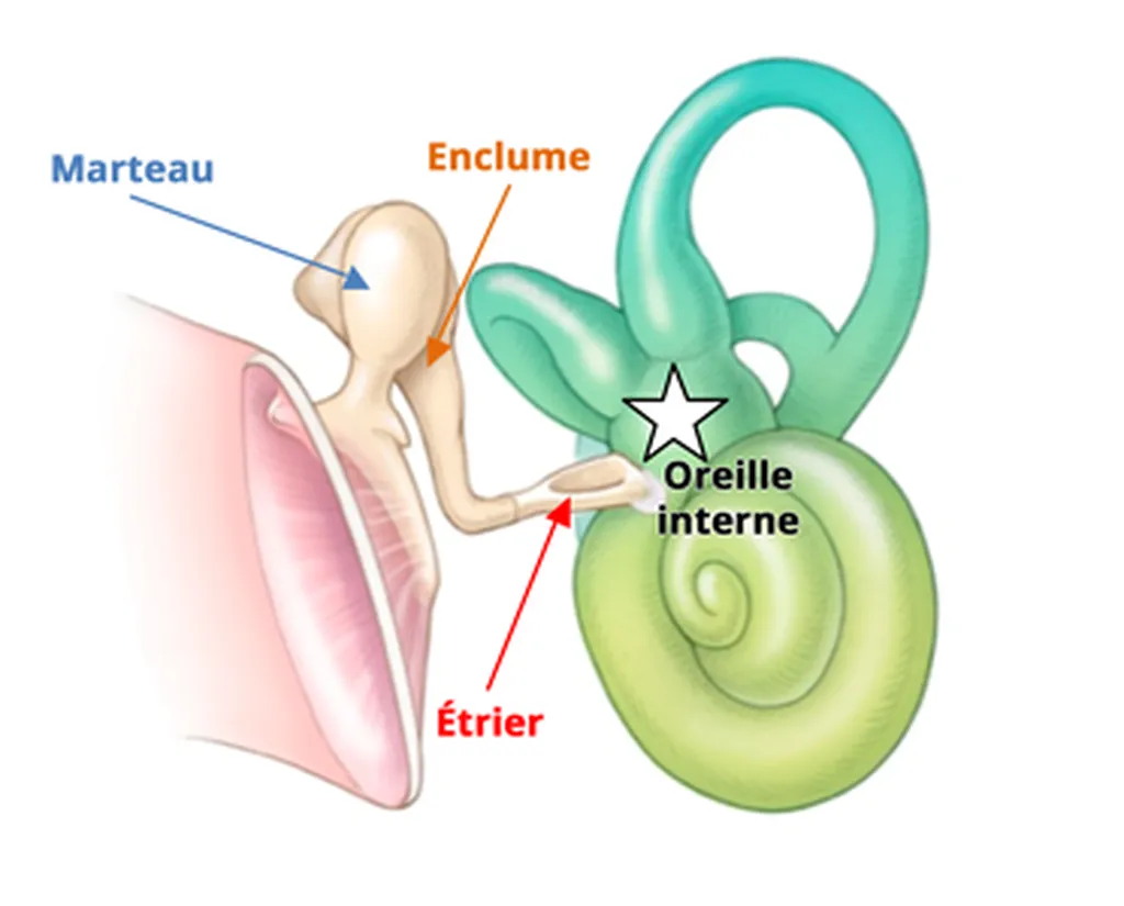 otospongiose : appareil auditif ou opération, que choisir ?