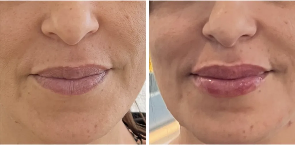 levres acide hyaluronique 