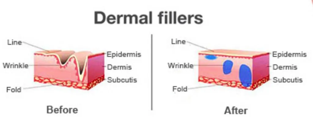 profhilo skinbooster structura polynucleotides