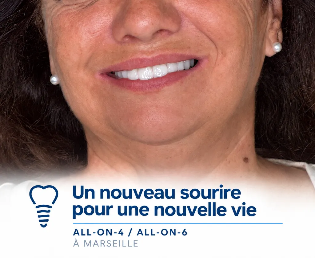 Dr Didier Tourrolier Implantologie – All-on-4 & All-on-6 à Marseille