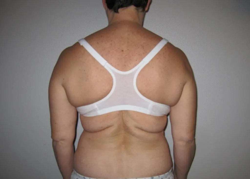 Body lift surgery in France: Dr Jean-François Pascal’s expertise in Lyon
