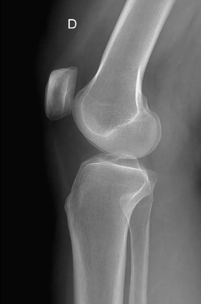 Faire une radiographie du genou dans notre centre d'imagerie médicale à Marseille