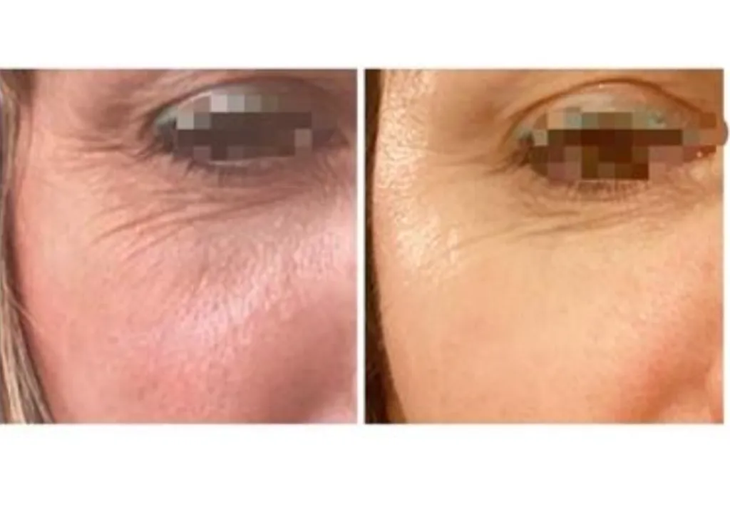 Traitement de la qualité de la peau avec mésothérapie à Paris