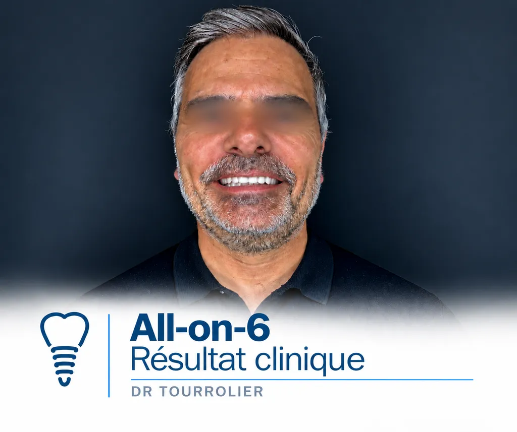 Résultat clinique All-on-6 sur implants dentaires – Dr Didier Tourrolier, Marseille