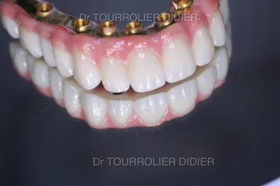 Meilleur spécialiste implant dentaire Avignon