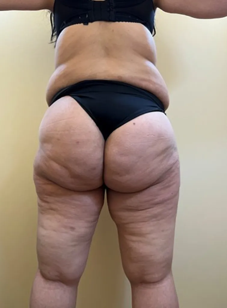 Chirurgie réparatrice extrême à Lyon – Super Bodylift & Remodelage corporel post‑amaigrissement