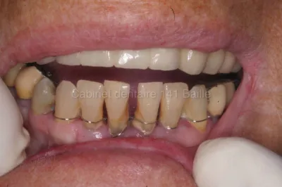 La maladie parodontale.Parodontologie.Dr Tourrolier Didier .13005 Marseille