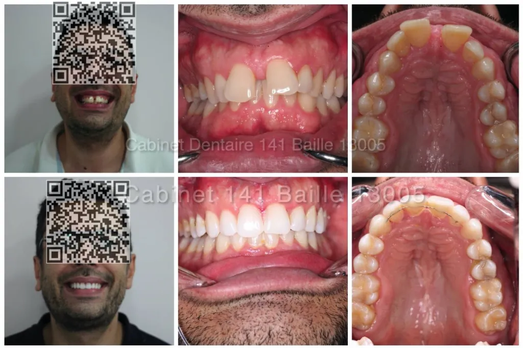 Invisalign avant apres marseille centre 
