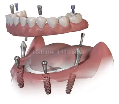 spécialiste implantation bouche complete 