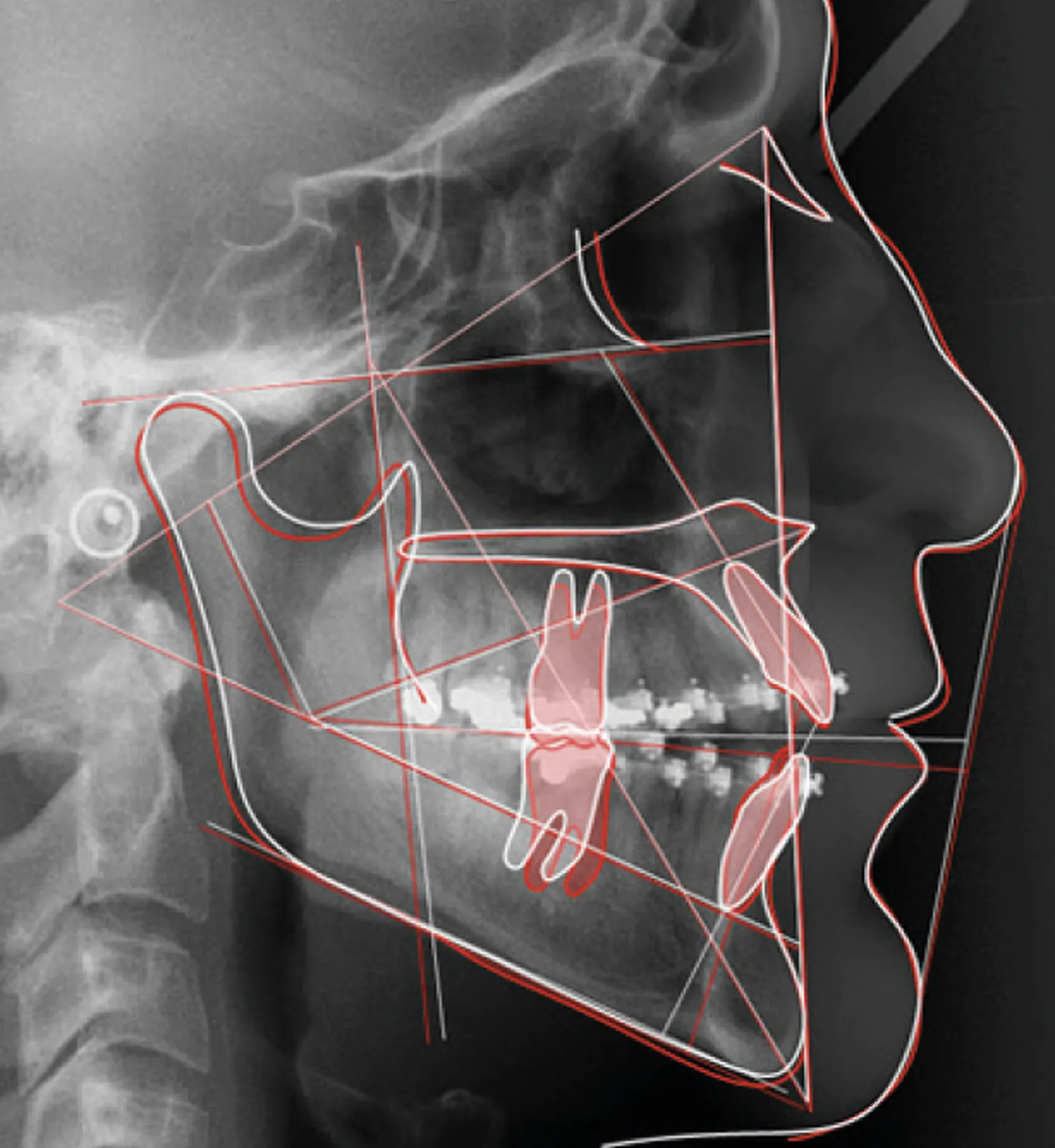 Owandy CEPH ANALYSIS