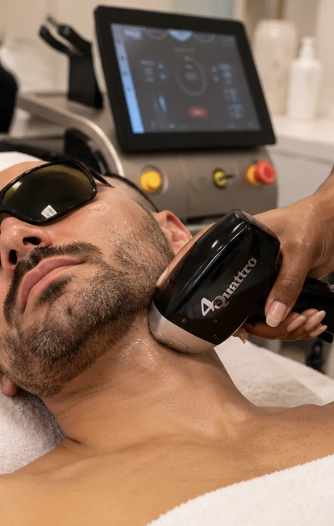 Épilation laser des contours de barbe et du cou chez un homme à Toulouse Croix-Daurade pour limiter les poils incarnés