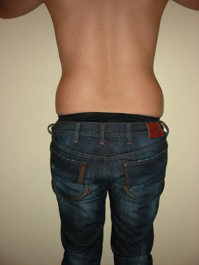 CHIRURGIE DE LA SILHOUETTE CHEZ L'HOMME, LA GYNCOMASTIE ET LE BODYLIFT