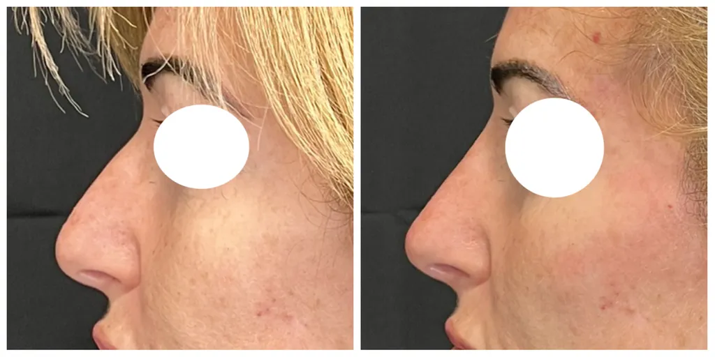 rhynoplastie médicale, Paris, acide hyaluronique, injection nez