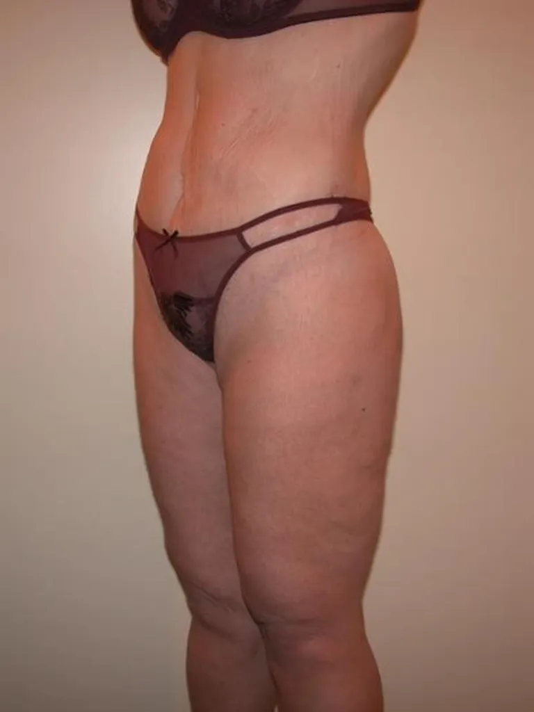 Chirurgie réparatrice extrême à Lyon – Super Bodylift & Remodelage corporel post‑amaigrissement