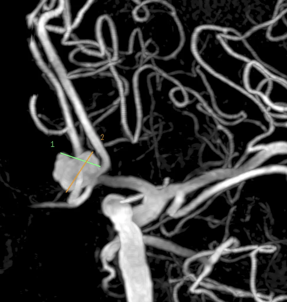 Anévrysme de l'artère communicante antérieure