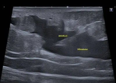 Réaliser une ponction sous échographie
