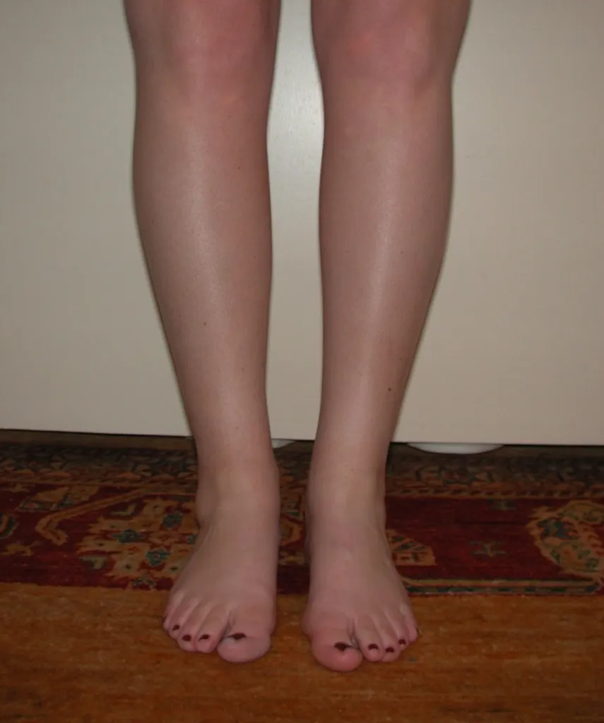 Liposuccion des mollets et chevilles à Lyon : l’expertise du Dr Jean-François Pascal pour affiner la jambe avec précision