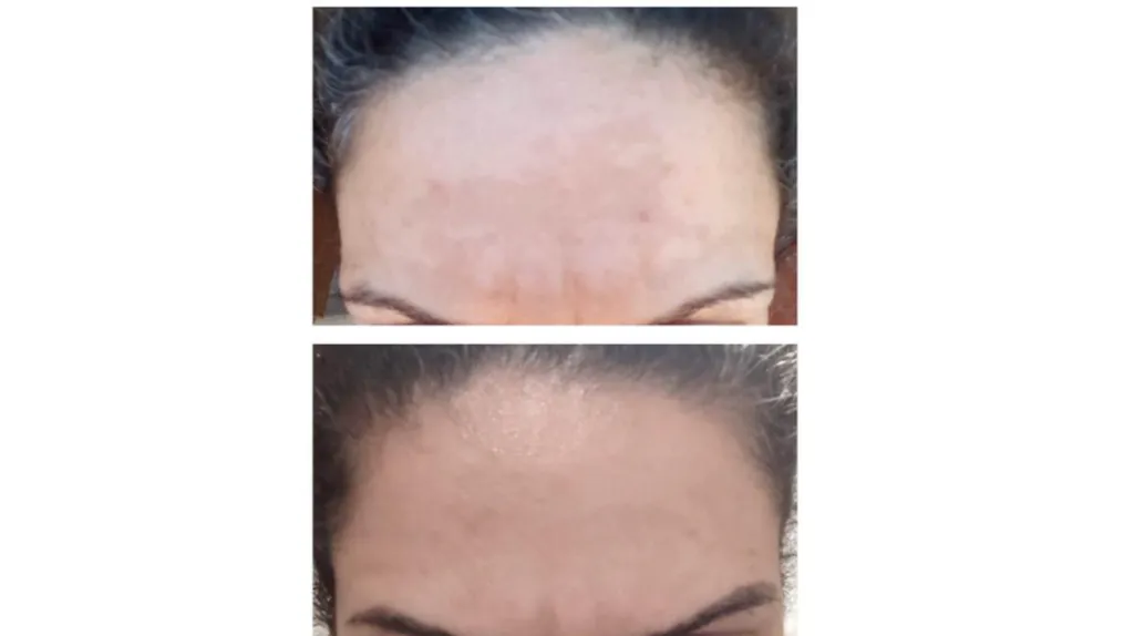 Traitement d’hyperpigmentation par peeling pour l'amélioration du mélasma