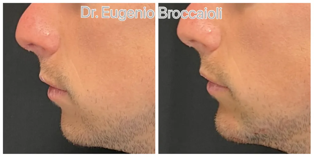 Acide hyaluronique menton neauvia profil Paris jaw line  