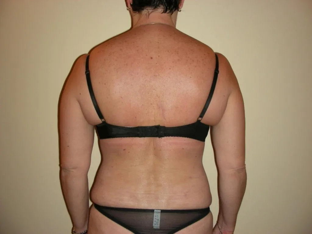 Body lift supérieur à Lyon : Réparer et redessiner le haut du tronc après amaigrissement