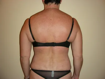 Body lift supérieur à Lyon : Réparer et redessiner le haut du tronc après amaigrissement