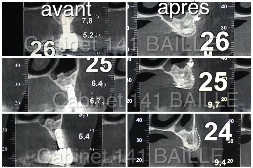 Régénération osseuse guidée a marseille Spécialiste