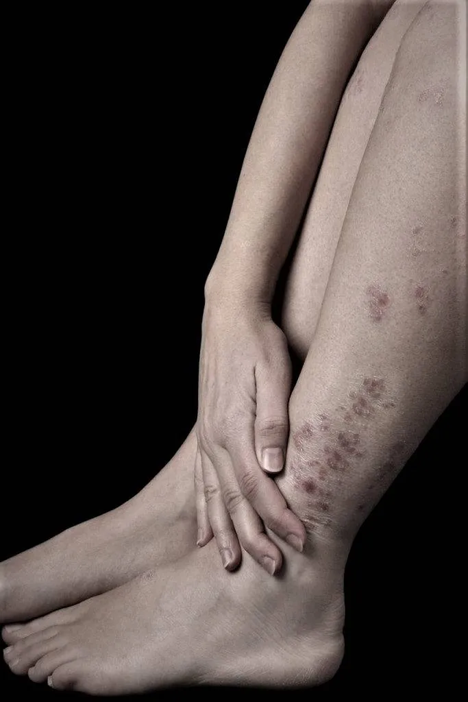 Eczéma psoriasis traité par l'acupuncture Lyon