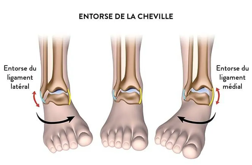 Entorses de cheville et de poignet manipulées et traitées par l'ostéopathie et l'acupuncture à Lyon