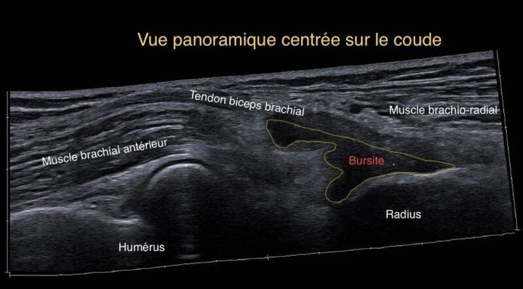 Echographie à la Rose : douleur du coude chez un employé du batiment.