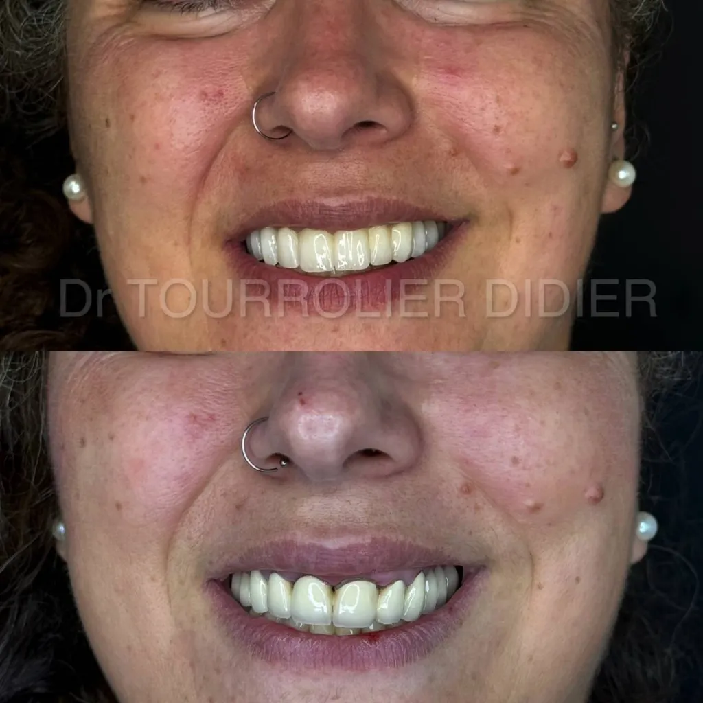 Docteur didier tourrolier spécialiste all on 6 et all on 4 France