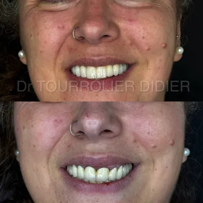 Docteur didier tourrolier spécialiste all on 6 et all on 4 France