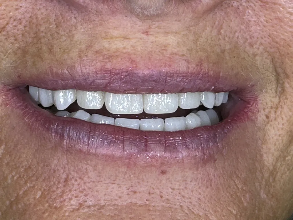 Suivi chirurgical All-on-6 expert en implantologie Marseille