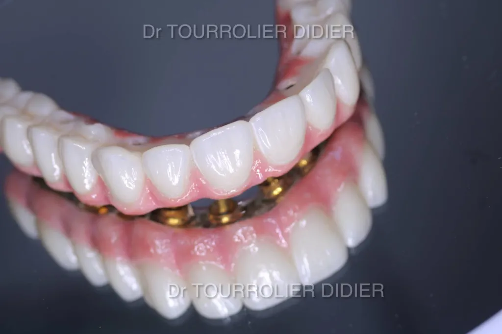 Spécialiste implant dentaire Avignon