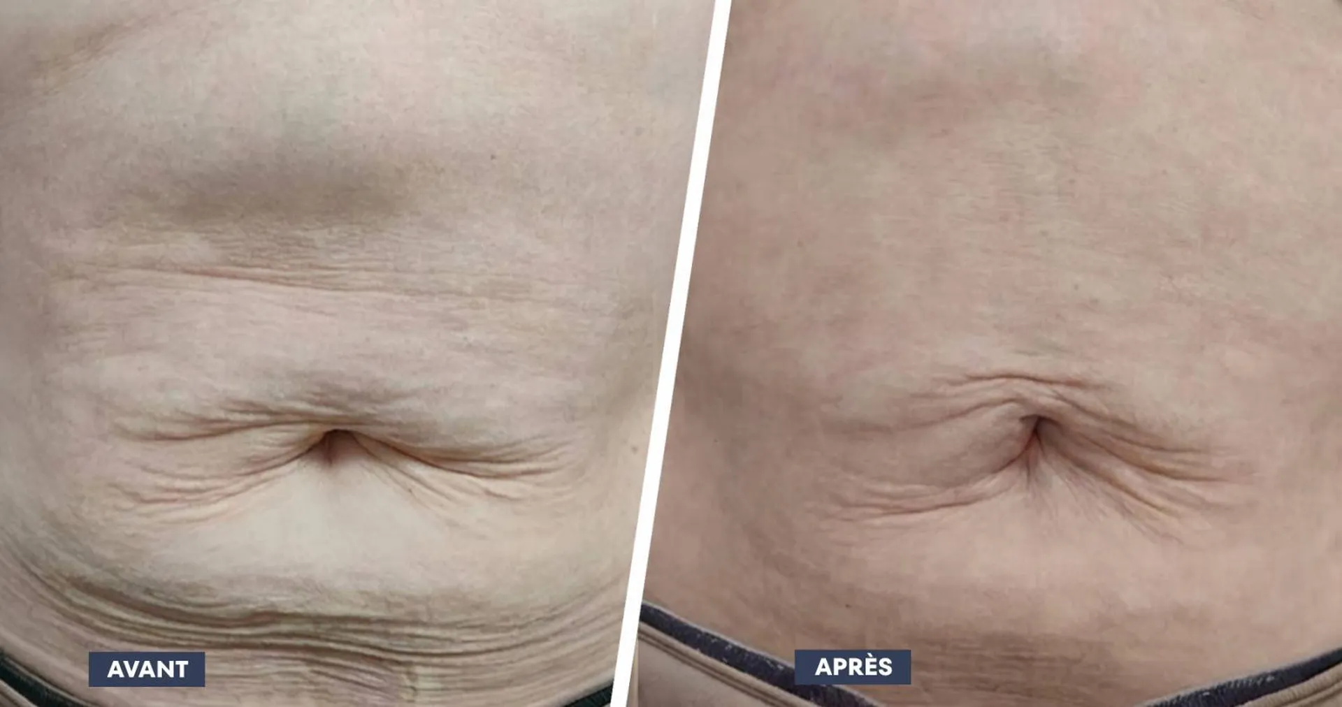 ProDeep ventre à Aix-en-Provence : raffermir la peau du ventre sans chirurgie