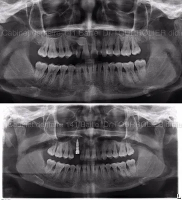 Traitement d'une canine INCLUSE ectopique par IMPLANTATION Immédiate