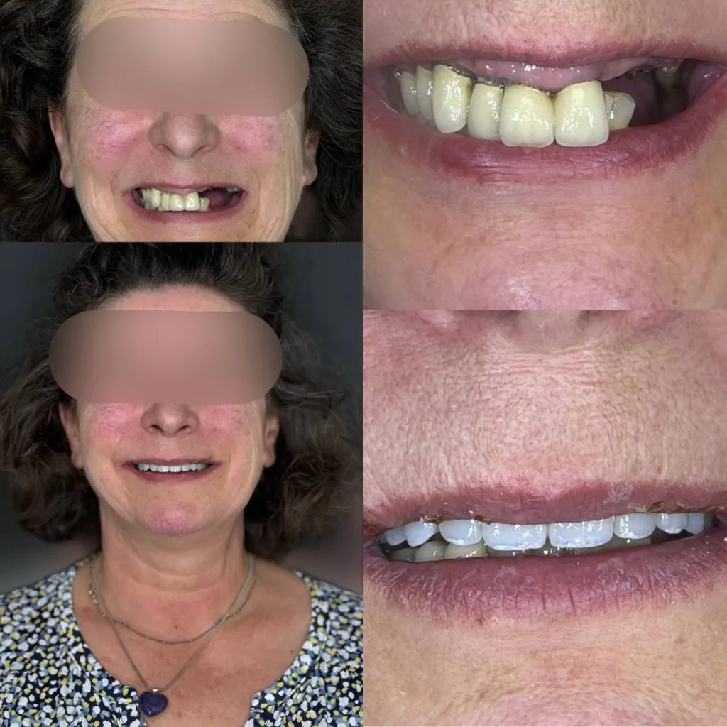 Notre zone d'activité pour ce servicePrix pour la pose d'une courronne