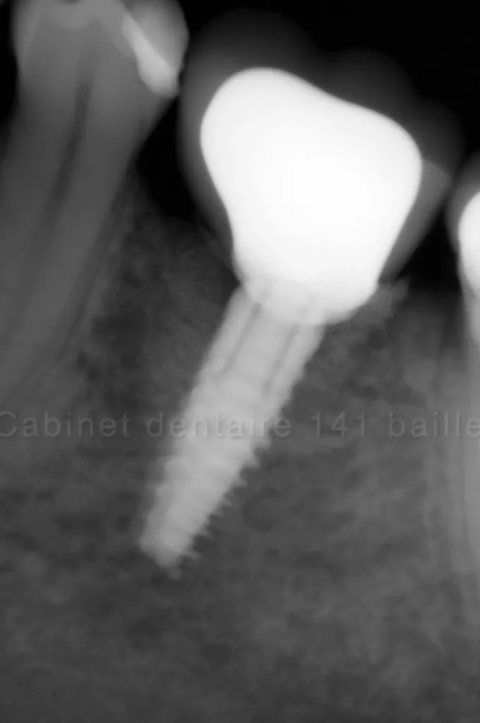 Spécialiste greffe osseuse implant Marseille