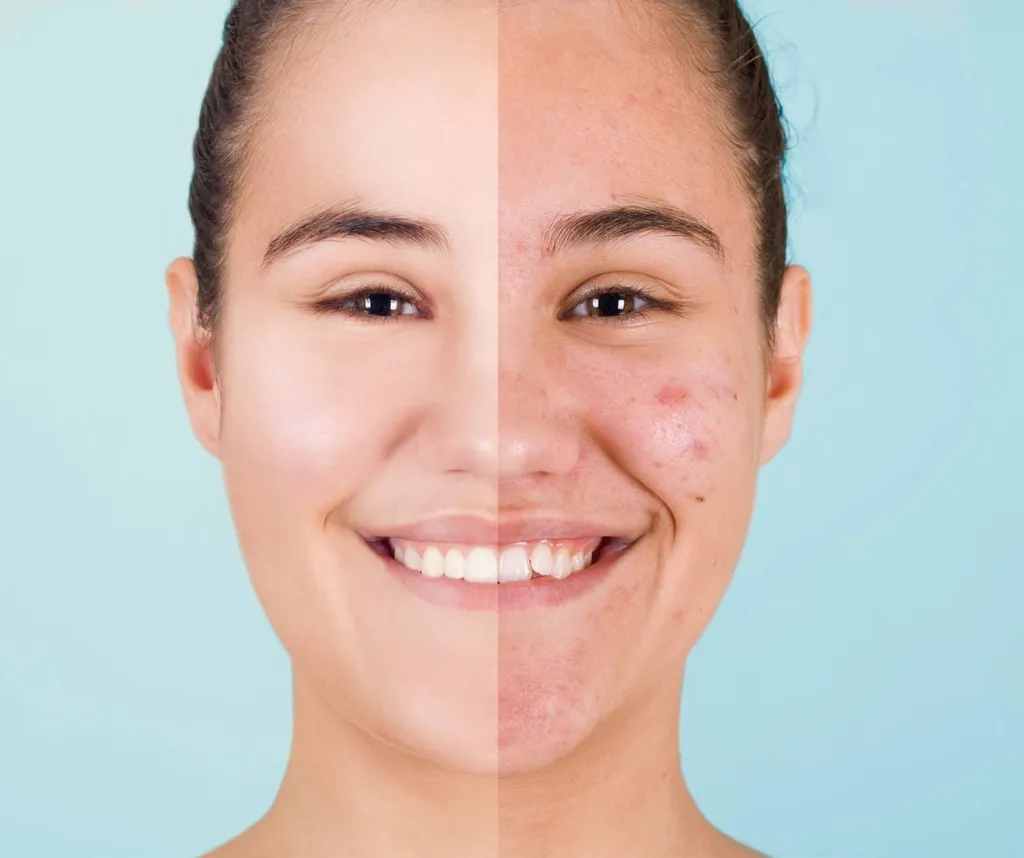 Comment traiter l'acné naturellement en institut de beauté à Roquevaire près d'Auriol et d'Aubagne
