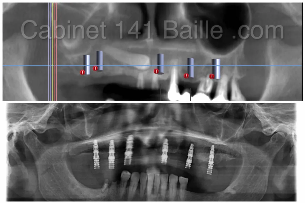 remplacer toutes ses dents par des implants a marseille