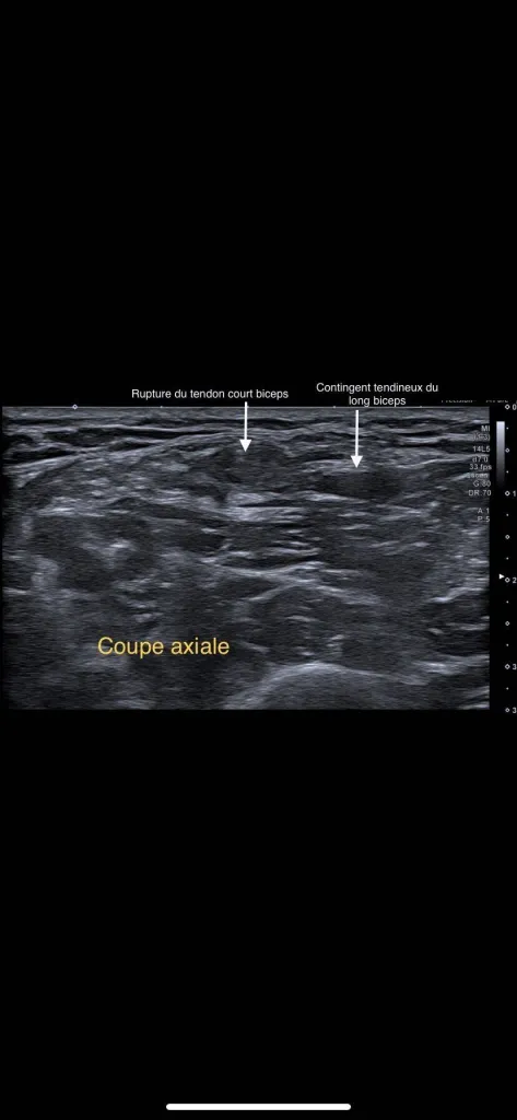 Echographie rue de Lodi : Perte de force de l'avant-bras