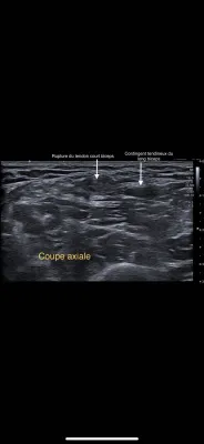 Echographie rue de Lodi : Perte de force de l'avant-bras