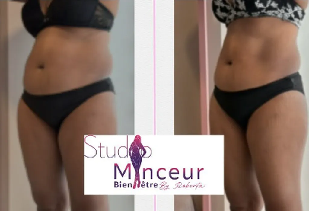 Des résultats visibles dès la première séance grâce à la cryolipolyse avec intelligence artificielle