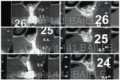 Spécialiste greffes osseuses implant marseille