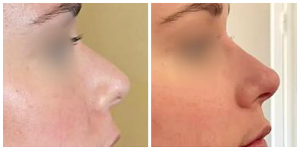 rhinoplastie medicale acide hyaluronique