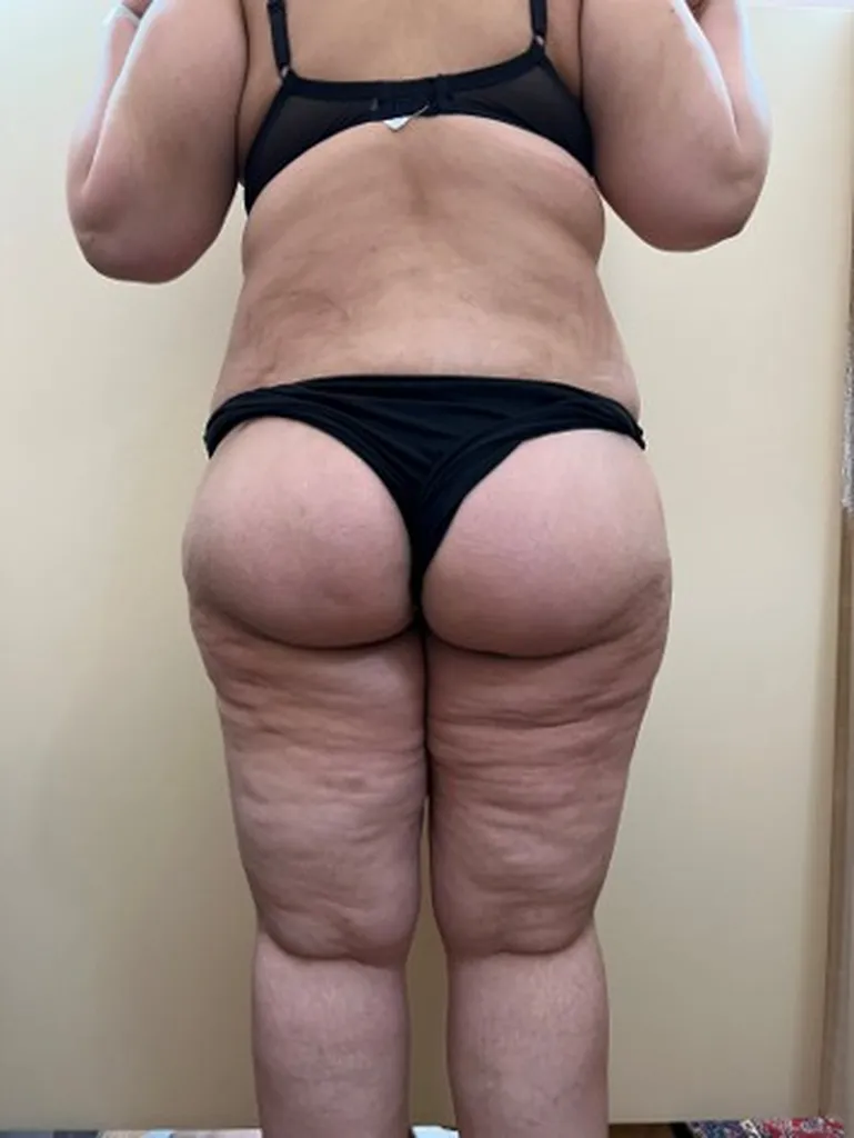 Chirurgie réparatrice extrême à Lyon – Super Bodylift & Remodelage corporel post‑amaigrissement