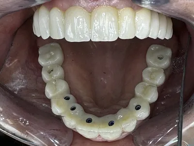 ontrôle implants All-on-6 pour assurer la longévité du traitement à Marseille